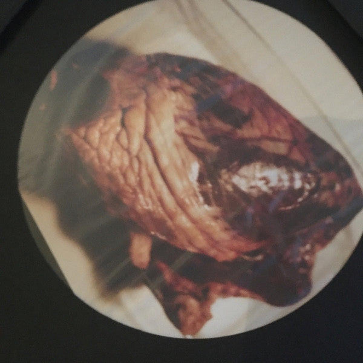 Akatana & Ombossa - Myocarde LP () M